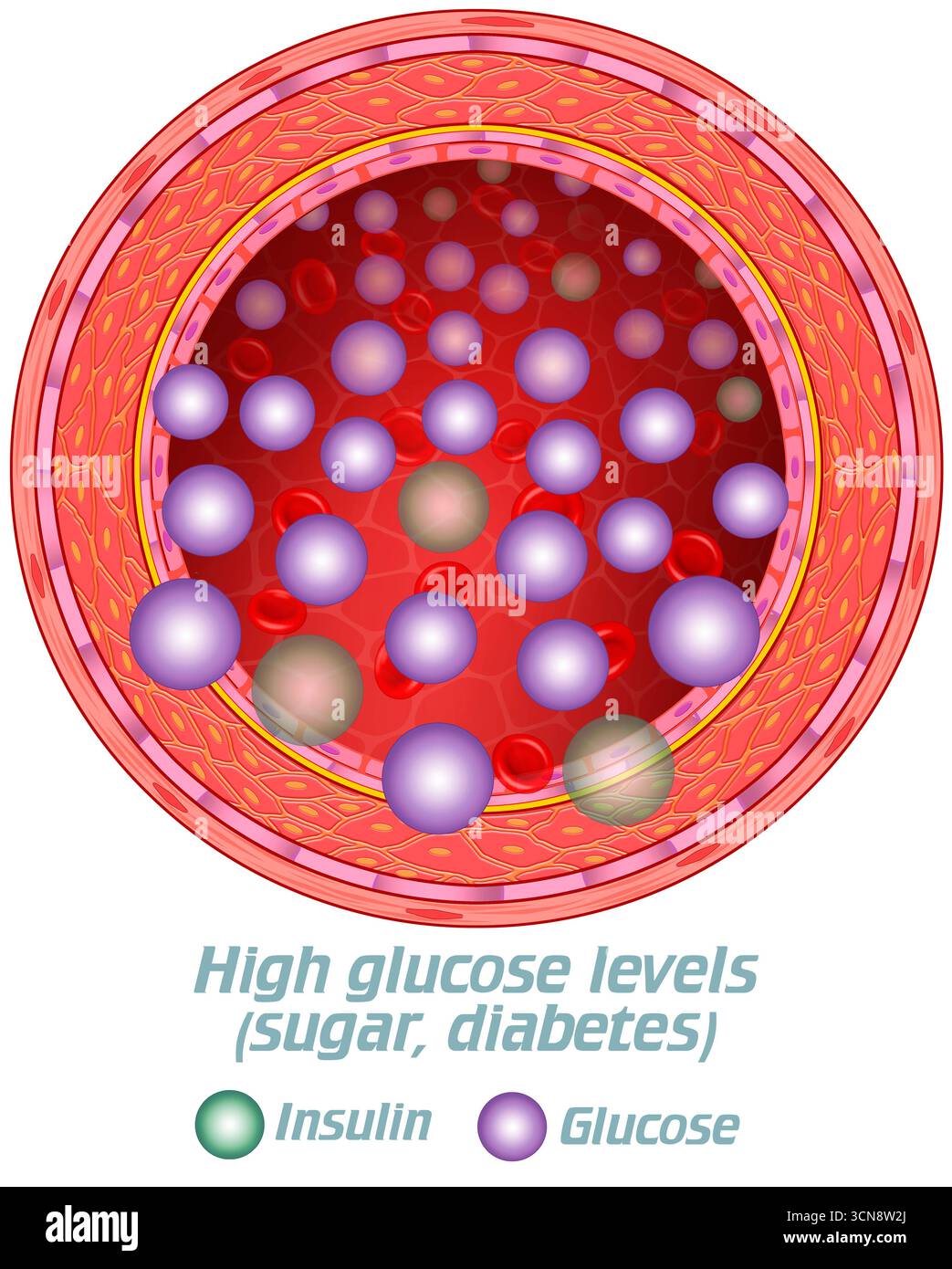 Abbildung einer Arterie in der Frontalansicht mit hohen Glukosespiegeln (violette Kugeln) und niedrigen Insulinspiegeln (grüne Kugeln). Diabetes ist eine Erkrankung, bei der der Blutzuckerspiegel aufgrund eines fehlenden wirksamen Ansprechens auf Insulin oder einer unzureichenden Produktion dieses Hormons durch die Bauchspeicheldrüse erhöht bleibt. Stockfoto