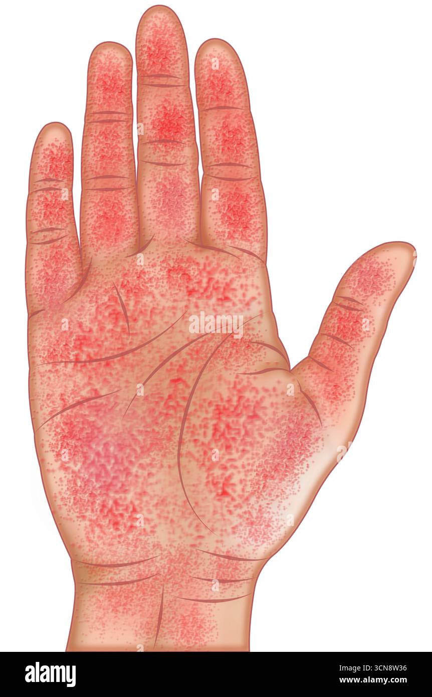 Illustration einer Hand mit reaktiver Arthritis. Dies ist eine Autoimmunreaktion, die durch eine bakterielle Infektion ausgelöst wird. Es kann Schwellungen und Schmerzen verursachen und kann sich mit Hautläsionen auf den Handflächen, wie Keratoderma blennorrhagica, manifestieren und ist mit einer Immunantwort verbunden. Stockfoto