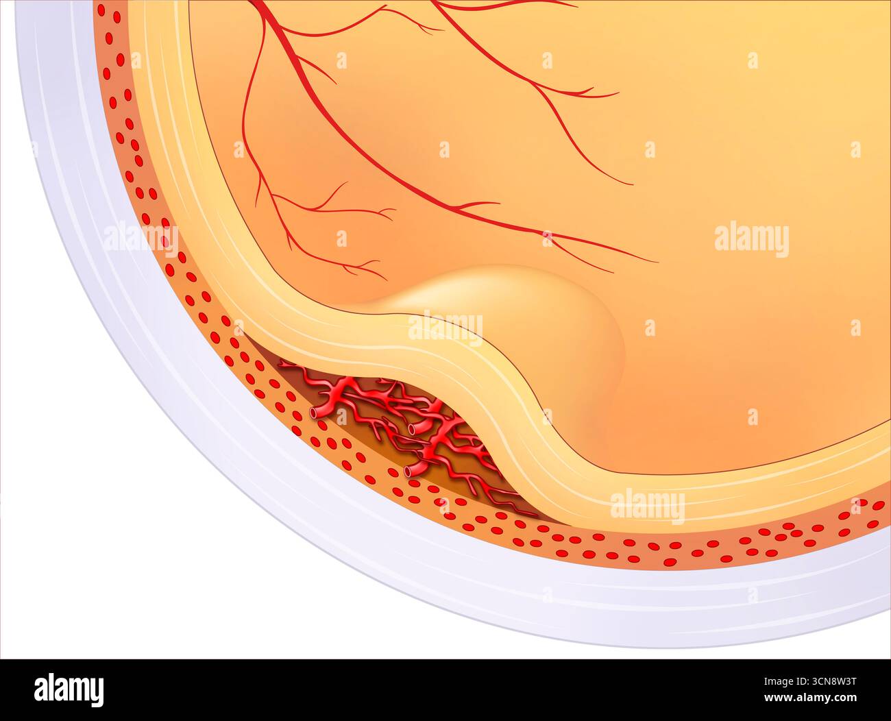 Abbildung einer altersbedingten Makuladegeneration (AMD), die zeigt, wie sich die Erkrankung auf die Makula auswirkt, den zentralen Teil der Netzhaut, der für das detaillierte Sehen verantwortlich ist. Im Laufe der Zeit kann das Altern die Zellen der Makula schädigen, was zu verschwommenem Sehen oder Verlust des zentralen Sehvermögens führen kann. Stockfoto
