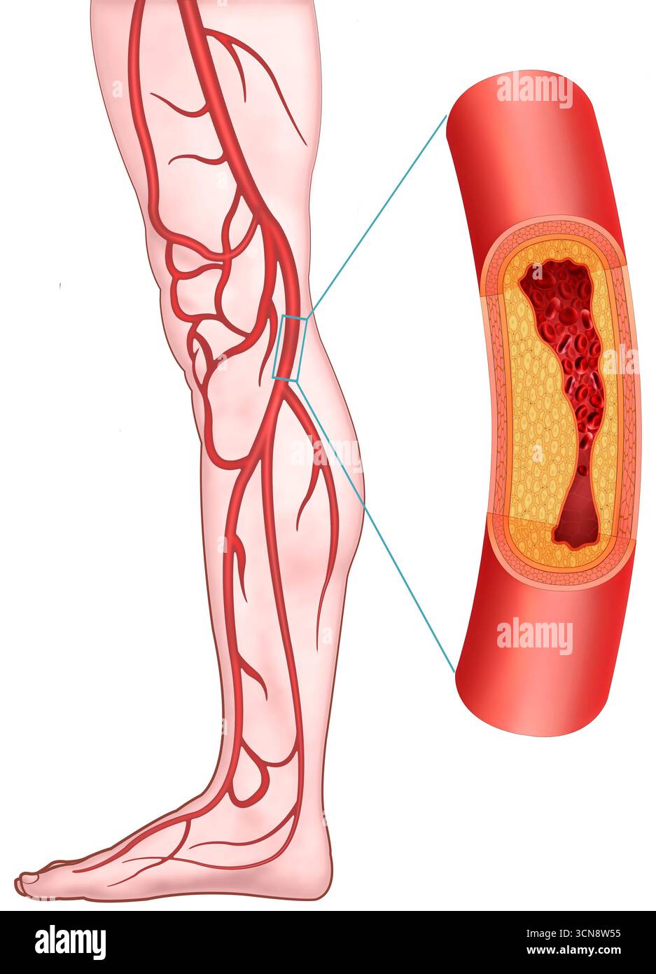 Illustration eines Beins mit fortgeschrittener Atherosklerose. In diesem Stadium verengen sich die Arterien aufgrund der Ansammlung von Plaques, die aus Lipiden und Cholesterin bestehen. Dieser Prozess verringert den Durchmesser der Blutgefäße, beeinträchtigt den arteriellen Fluss und erhöht das Risiko für schwerwiegende kardiovaskuläre Ereignisse. Stockfoto