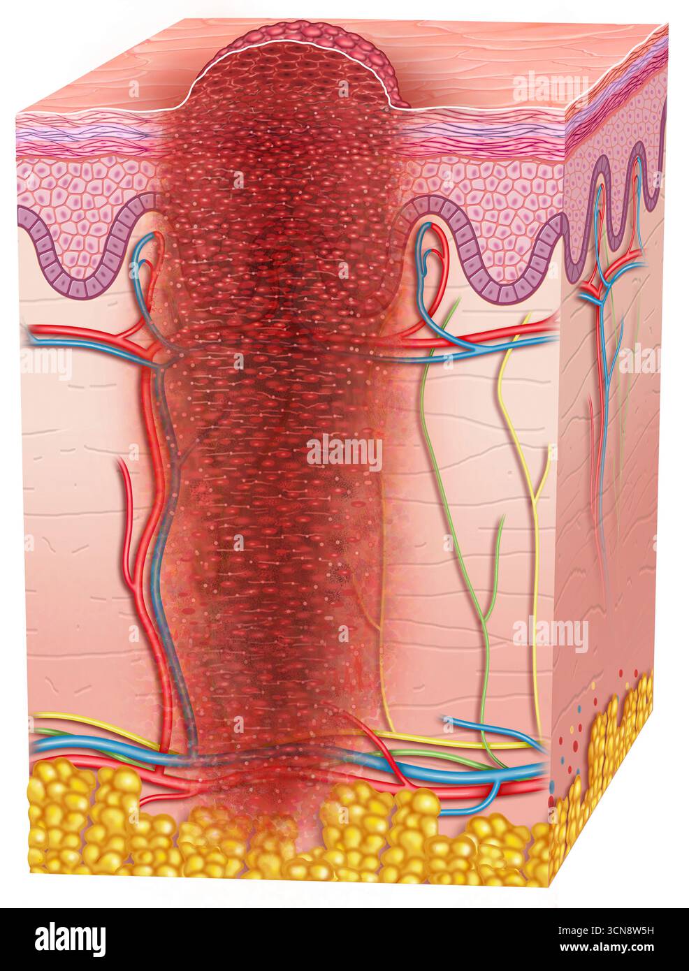 Illustration der Haut mit fortgeschrittenem Melanom. Das Melanom im Stadium IV ist gekennzeichnet durch die Ausbreitung von Krebszellen in entfernte Körperbereiche, jenseits von Venen, Arterien, Lymphknoten und anderen Organen, die Metastasen verursachen. Stockfoto