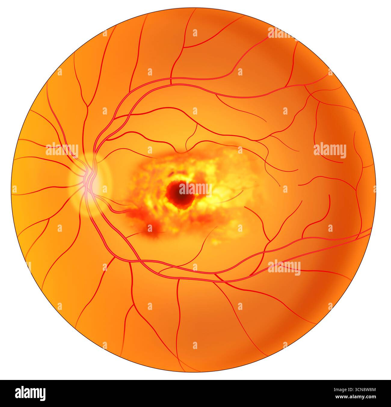 Illustration der Makuladegeneration, einer altersbedingten Augenkrankheit. Diese Augenerkrankung zerstört langsam das zentrale Sehen, den Teil des Auges, der das scharfe Vorwärtssehen steuert, und macht es schwierig, feine Details zu lesen und zu sehen. Diese Krankheit tritt am häufigsten bei Menschen über 60 Jahren auf. Stockfoto