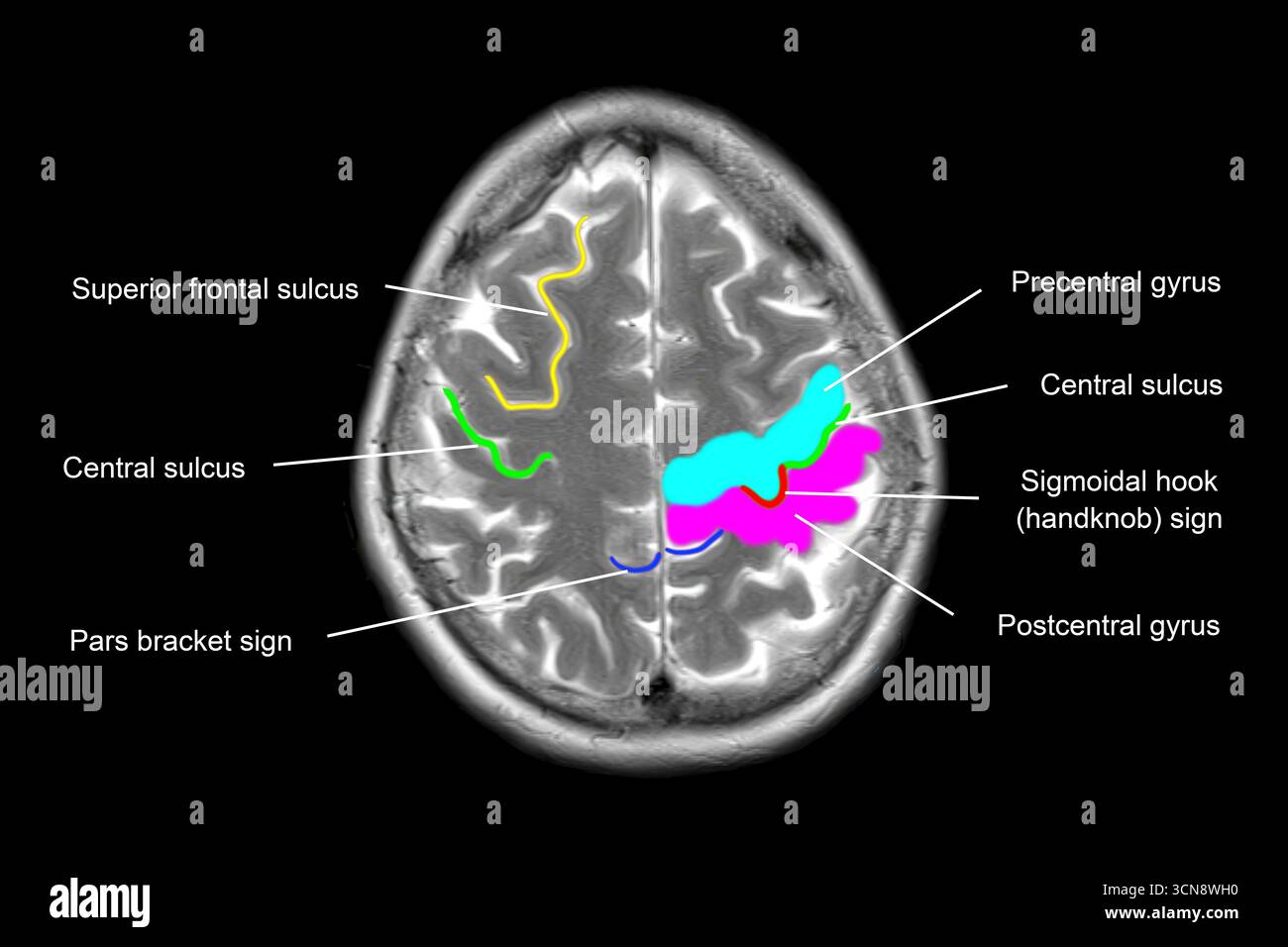 Magnetresonanztomographie (MRT), die normale Hirnanatomie mit markierten Hauptstrukturen zeigt. Stockfoto