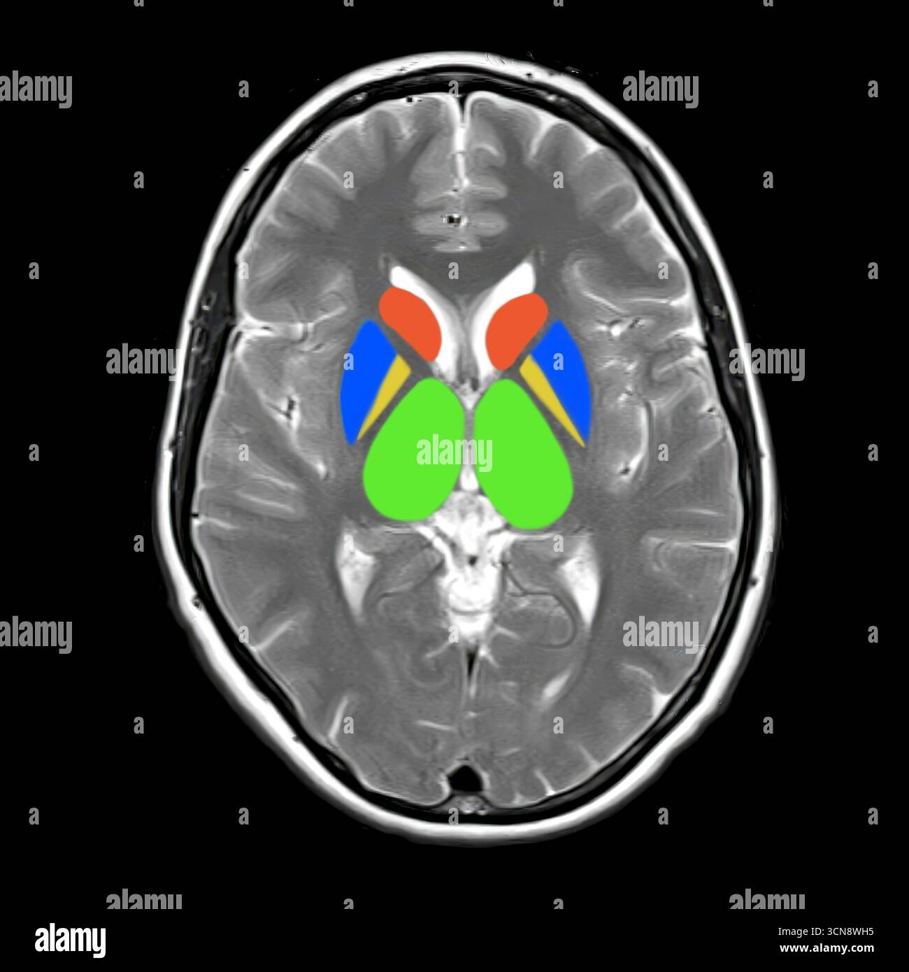 Magnetresonanztomographie (MRT) mit normaler Hirnanatomie mit farbigen Basalganglien (Nucleus caudatus rot, Putamen blau, Globus pallidus gelb) und Thalami (grün). Stockfoto