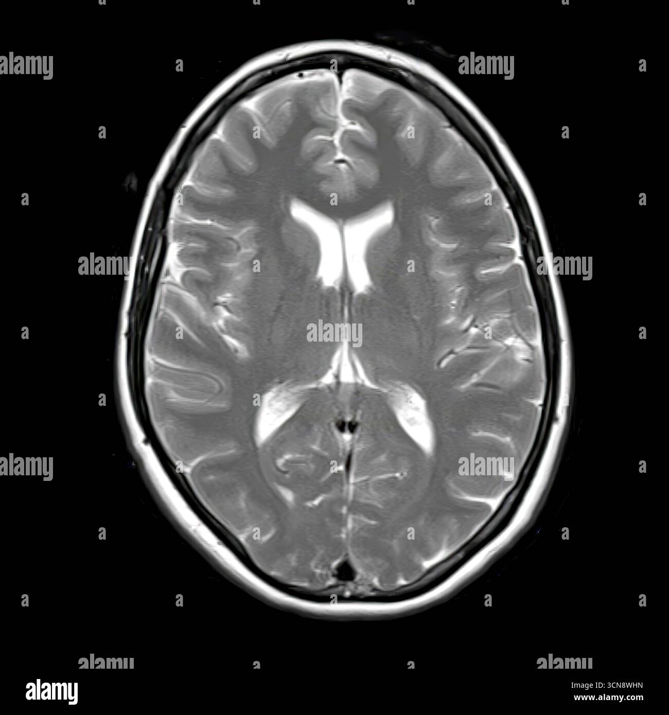 Magnetresonanztomographie (MRT) mit normaler Anatomie der lateralen Ventrikel, des Thalamus und der Basalganglien ohne sichtbare Pathologie. Stockfoto