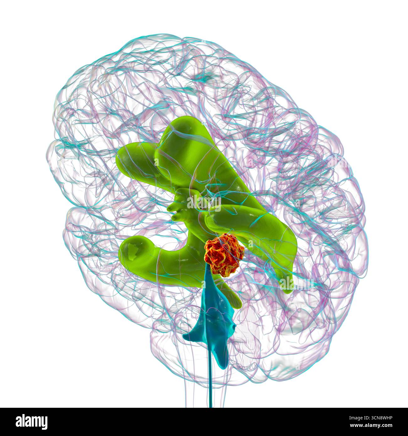 Illustration des vergrößerten lateralen und dritten Ventrikels des Gehirns (Hydrozephalus), hervorgerufen durch einen Hirntumor, der den Aquädukt des Gehirns komprimiert. Stockfoto