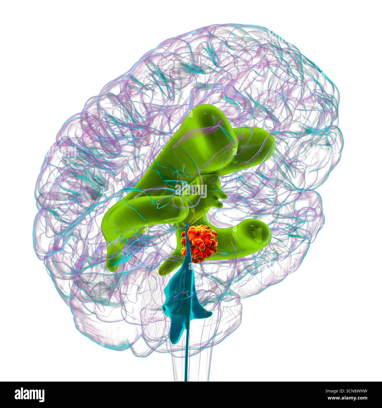 Darstellung der vergrößerten lateralen und dritten Ventrikel des Gehirns (Hydrozephalus), hervorgerufen durch einen Hirntumor, der den Aquädukt des Gehirns komprimiert. Stockfoto