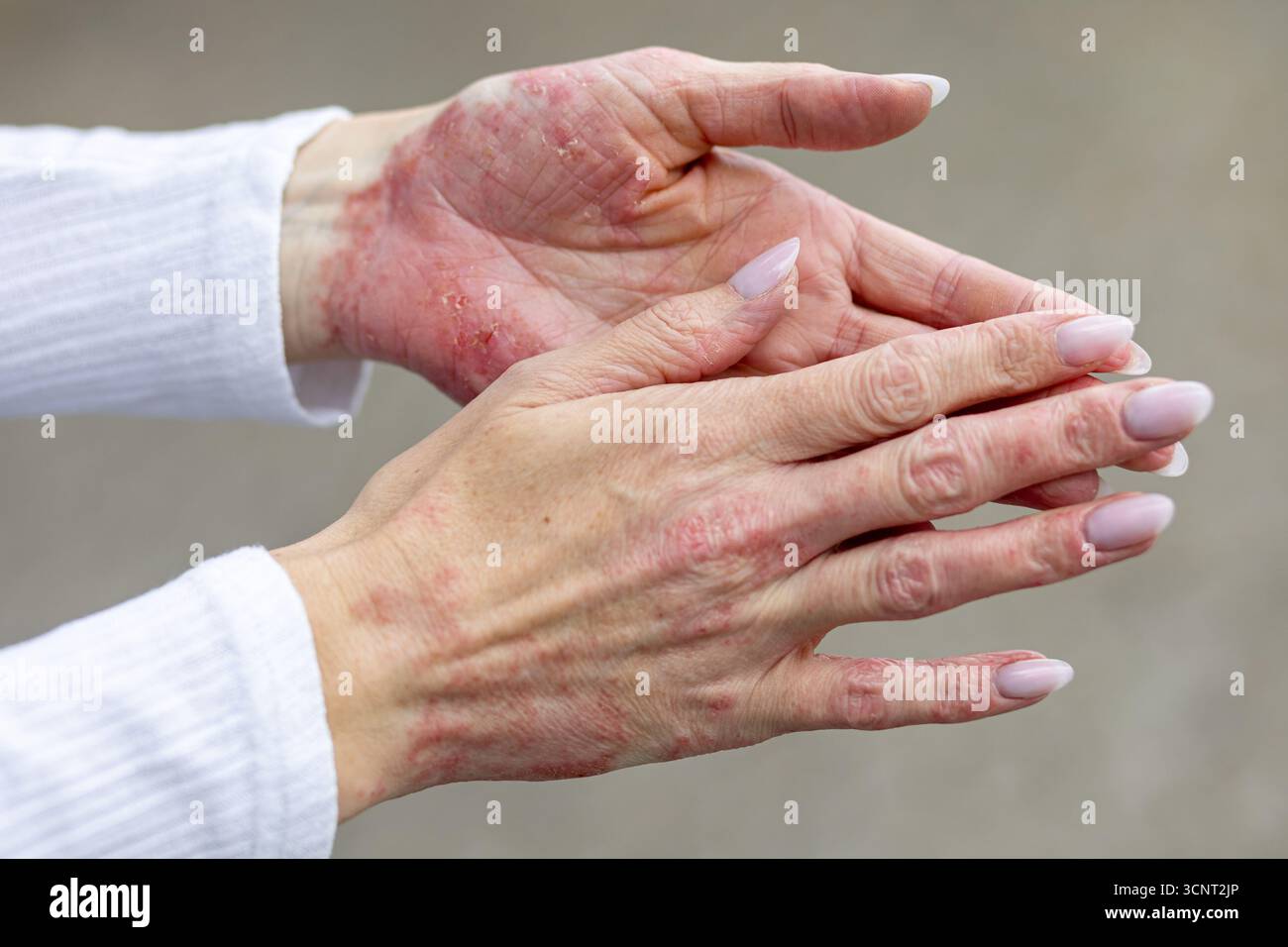 Die Haut an den Händen zeigt Flecken von Ekzemen und Psoriasis. Die Person reibt sich sanft die Hände aneinander, während sie einen ruhigen Tag im Freien genießt, Surro Stockfoto
