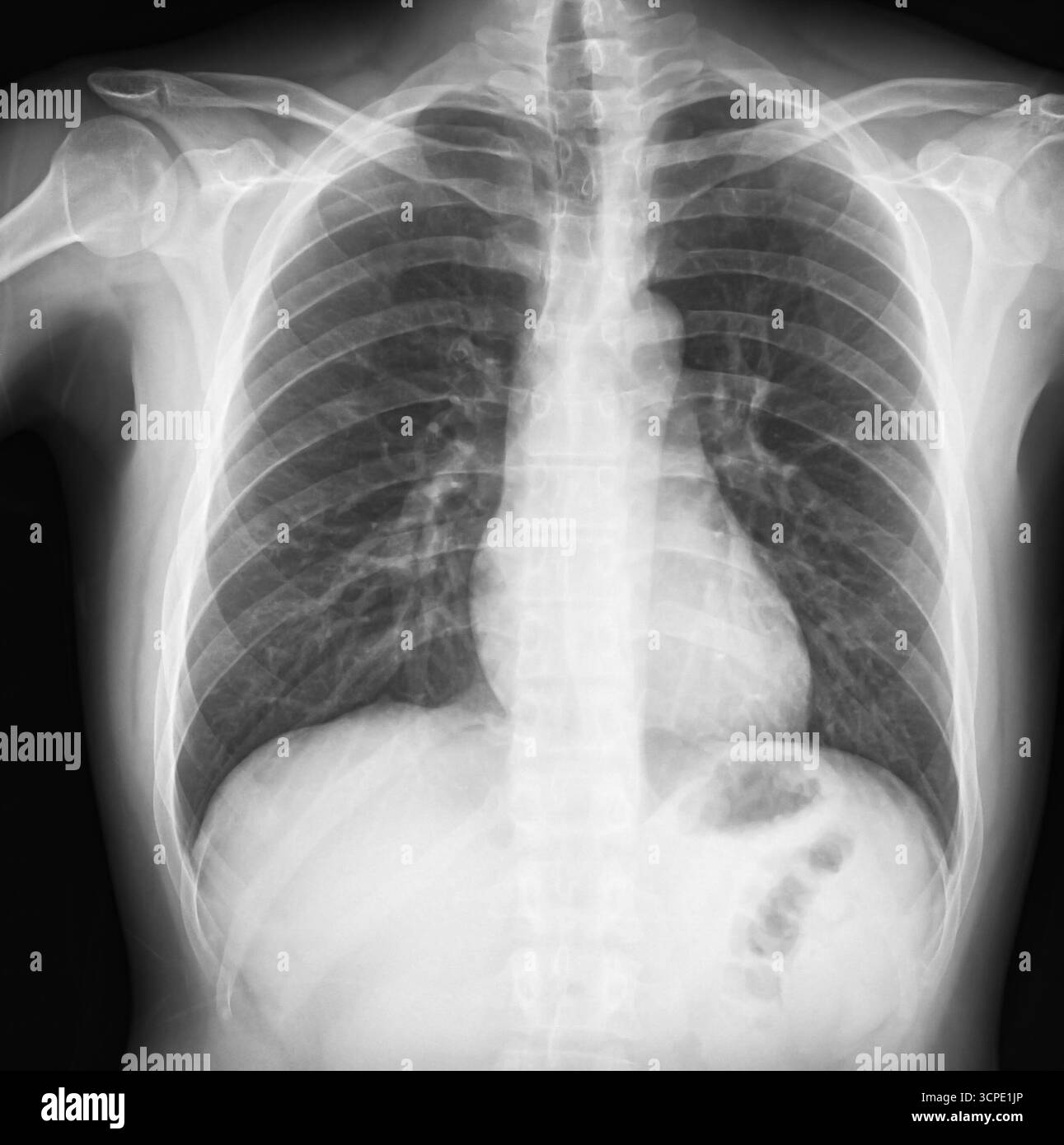 Thoraxröntgenaufnahme mit Lunge, Wirbelsäule und Rippen mit medizinischen Bildgebungsdetails. Schultergelenk, Sehnen- und Knochenverletzungen. Gesundheitsfilmkonzept Stockfoto