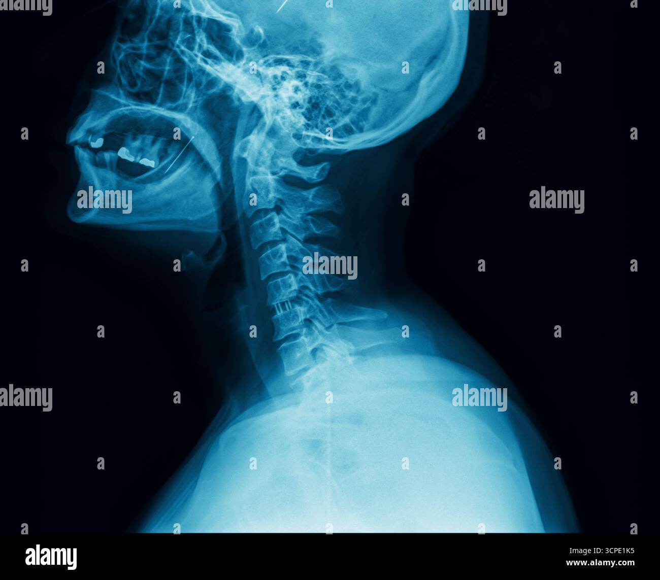 Laterale Röntgenaufnahme des menschlichen Halses und der Halswirbelsäule auf schwarzem Hintergrund. Bild der medizinischen Diagnostik. Wirbel, Schädelbasis und Atemwege Stockfoto