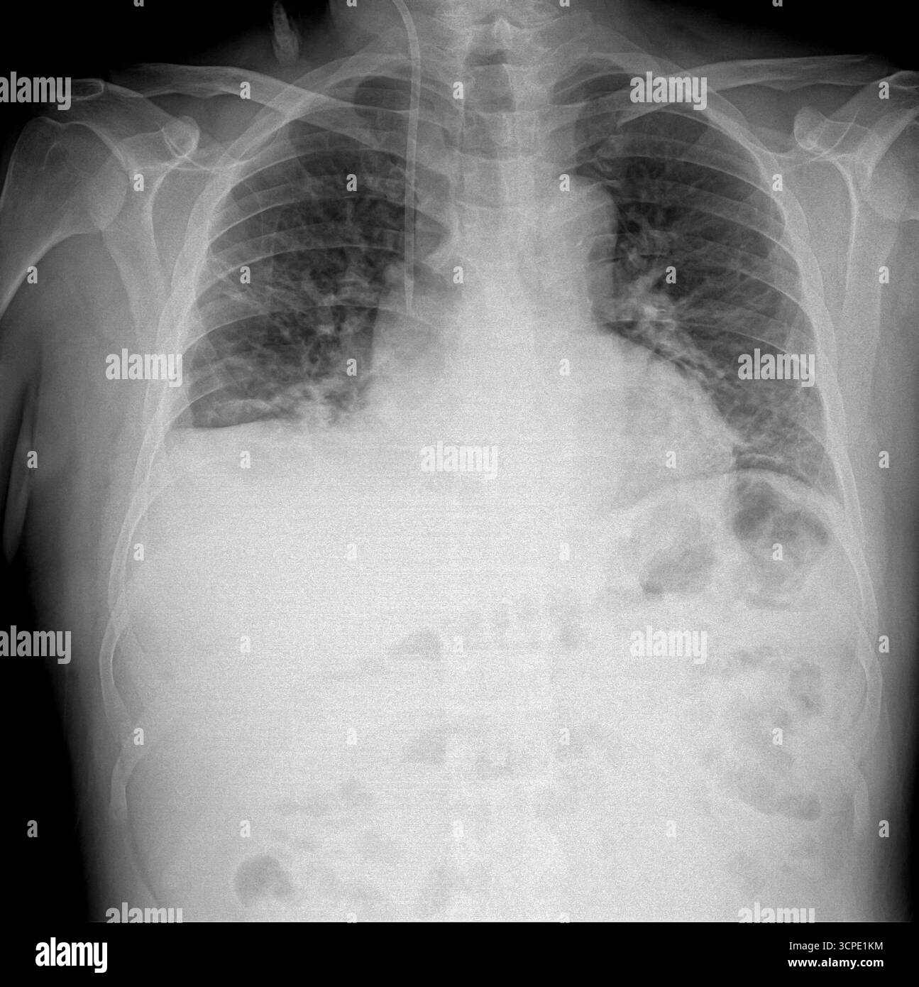 Thoraxröntgenaufnahme mit Lunge, Wirbelsäule und Rippen mit medizinischen Bildgebungsdetails. Schultergelenk, Sehnen- und Knochenverletzungen. Gesundheitsfilmkonzept Stockfoto