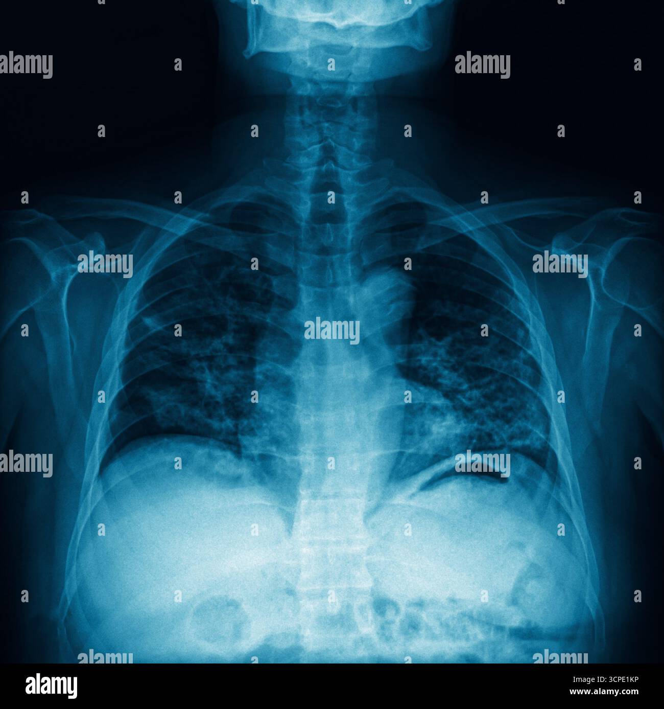 Thoraxröntgenaufnahme mit Lunge, Wirbelsäule und Rippen mit medizinischen Bildgebungsdetails. Schultergelenk, Sehnen- und Knochenverletzungen. Gesundheitsfilmkonzept Stockfoto