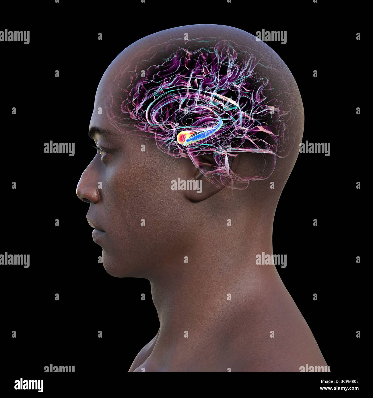 Abbildung eines menschlichen Hirnmittelschnitts mit hervorgehobener Amygdala (rot) und Hippocampus (blau). Dies sind Schlüsselregionen, die von Alzheimer-Erkrankungen betroffen sind Stockfoto