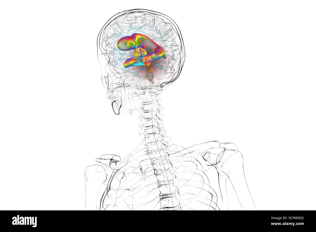 Darstellung der vergrößerten lateralen und dritten Ventrikel des Gehirns (Hydrozephalus), hervorgerufen durch einen Hirntumor, der den Aquädukt des Gehirns komprimiert. Stockfoto