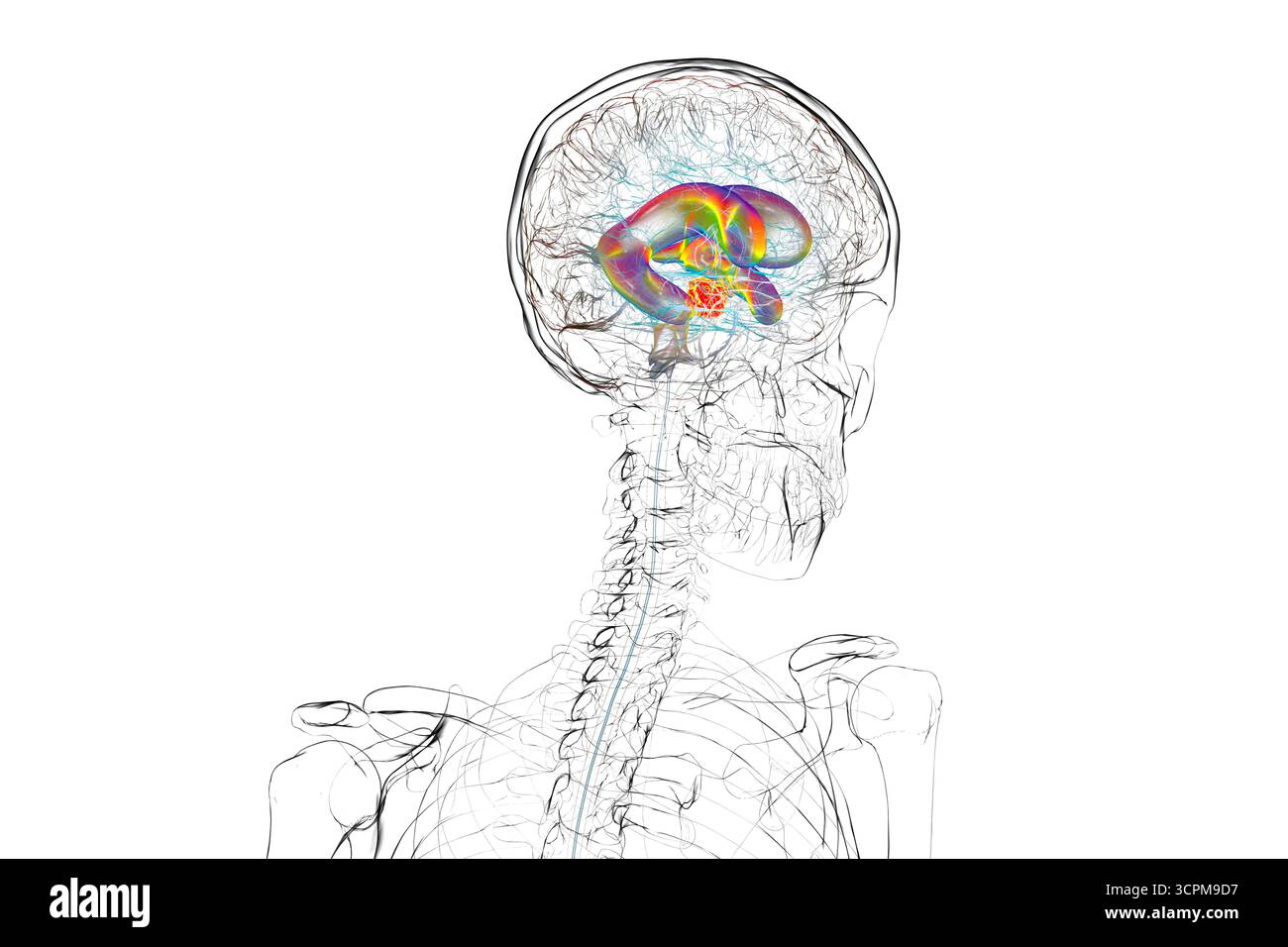 Darstellung der vergrößerten lateralen und dritten Ventrikel des Gehirns (Hydrozephalus), hervorgerufen durch einen Hirntumor, der den Aquädukt des Gehirns komprimiert. Stockfoto