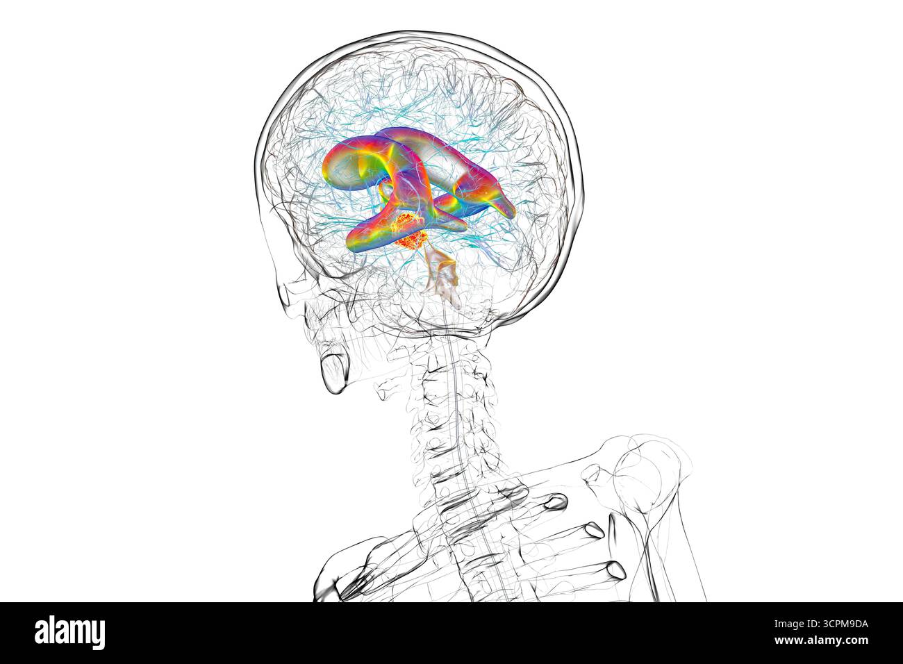 Darstellung der vergrößerten lateralen und dritten Ventrikel des Gehirns (Hydrozephalus), hervorgerufen durch einen Hirntumor, der den Aquädukt des Gehirns komprimiert. Stockfoto