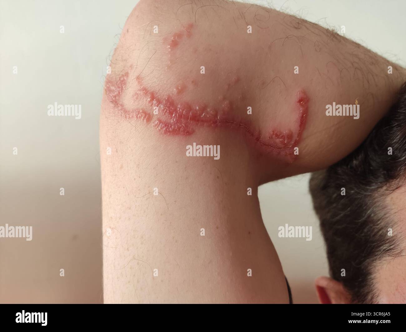 Chemische Verbrennung einer Rhopilema nomadica Qualle am Arm eines Mannes Stockfoto