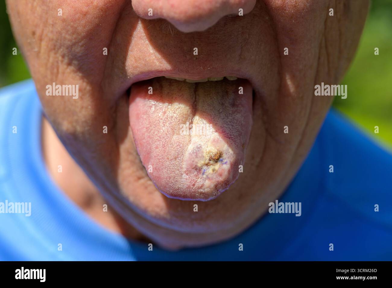 Nahaufnahme der Zunge älterer Männer mit sichtbarer Läsion. Stockfoto