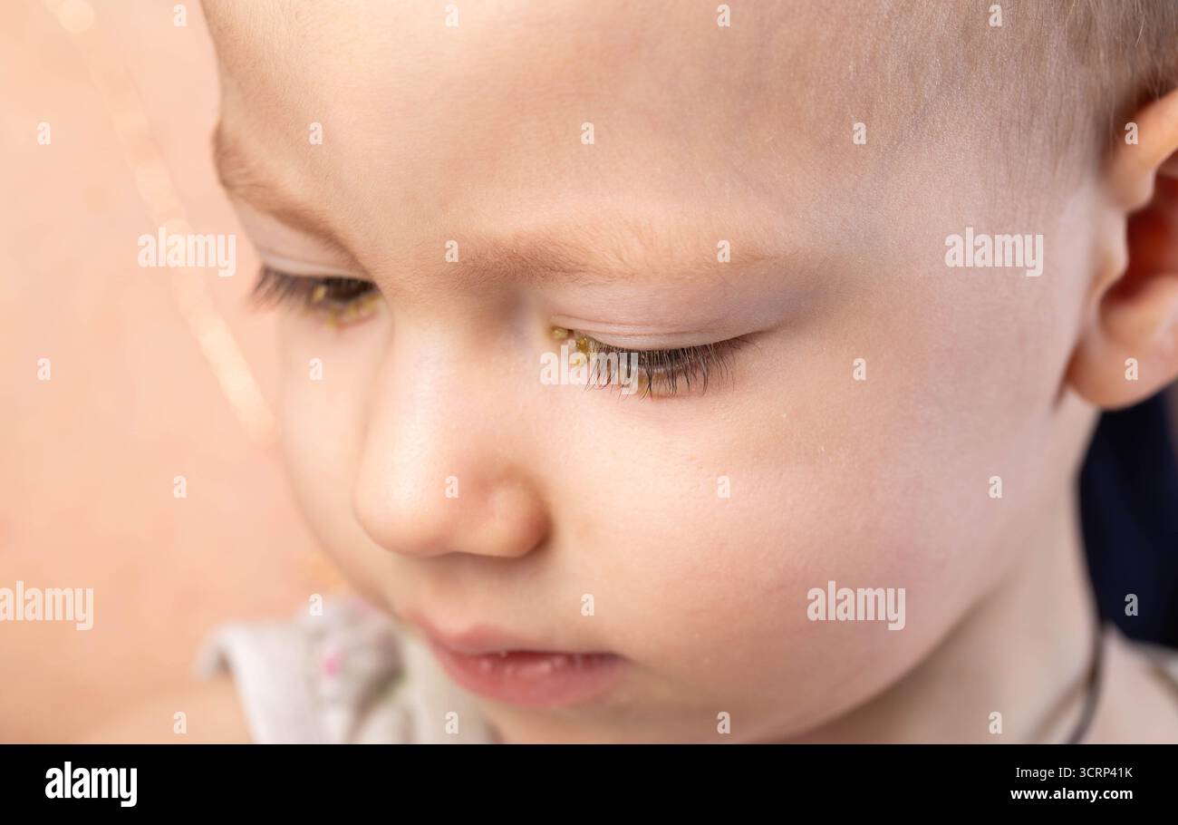 Kleiner Junge mit Eiter in den Augen, die Krankheit des Jungen ist bakterielle Bindehautentzündung. Virusinfektion der Augen. Stockfoto