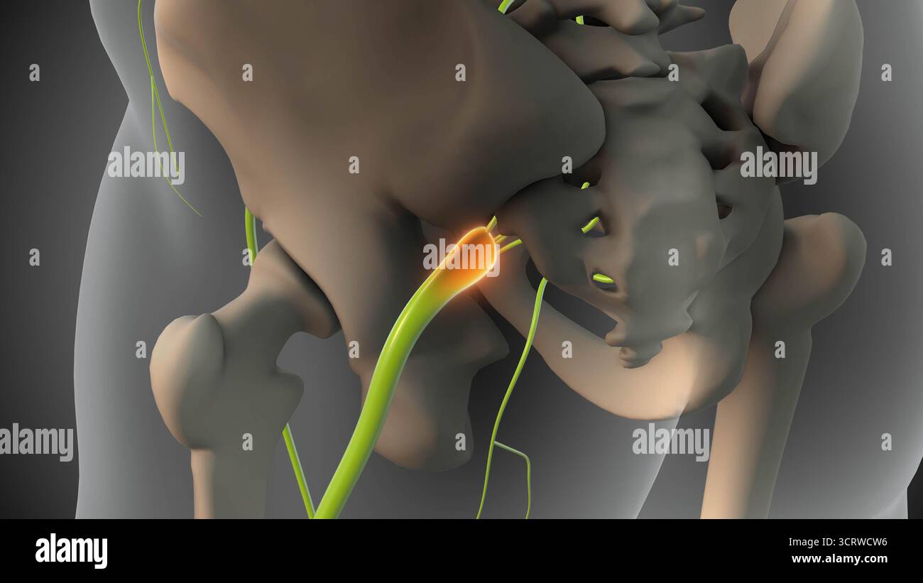 Becken mit Ischiasnerventumor Stockfoto