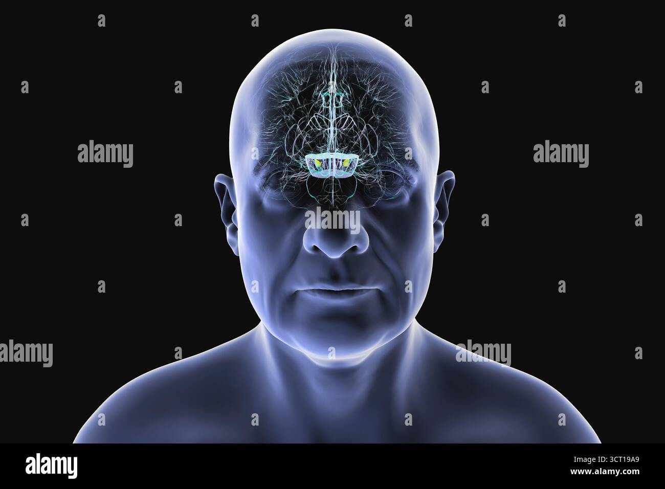 Illustration eines menschlichen Gehirns mit degenerierter Substantia nigra bei Morbus Parkinson, der Verlust pigmentierter Nervenzellen im Mittelhirn im Zusammenhang mit motorischer Dysfunktion zeigt. Vorderansicht. Stockfoto