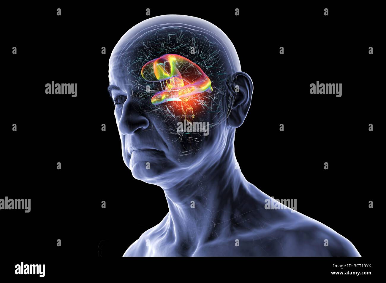 Darstellung der vergrößerten lateralen und dritten Ventrikel des Gehirns (Hydrozephalus) bei einer Seniorin. Dies wird durch einen Hirntumor verursacht, der den Aquädukt des Gehirns komprimiert. Stockfoto