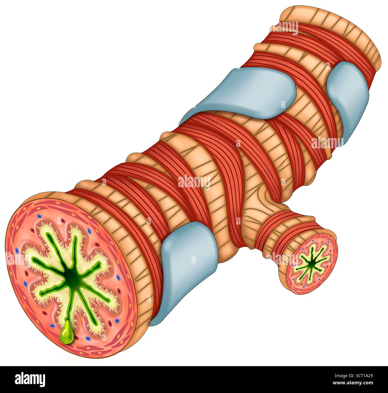 Abbildung eines Segments mit Asthma bronchiale mit Entzündung, überschüssigem Schleim und ausgeprägter Kontraktion der glatten Muskulatur, die zu einer deutlichen Verengung dieser Atemwege führt. Stockfoto