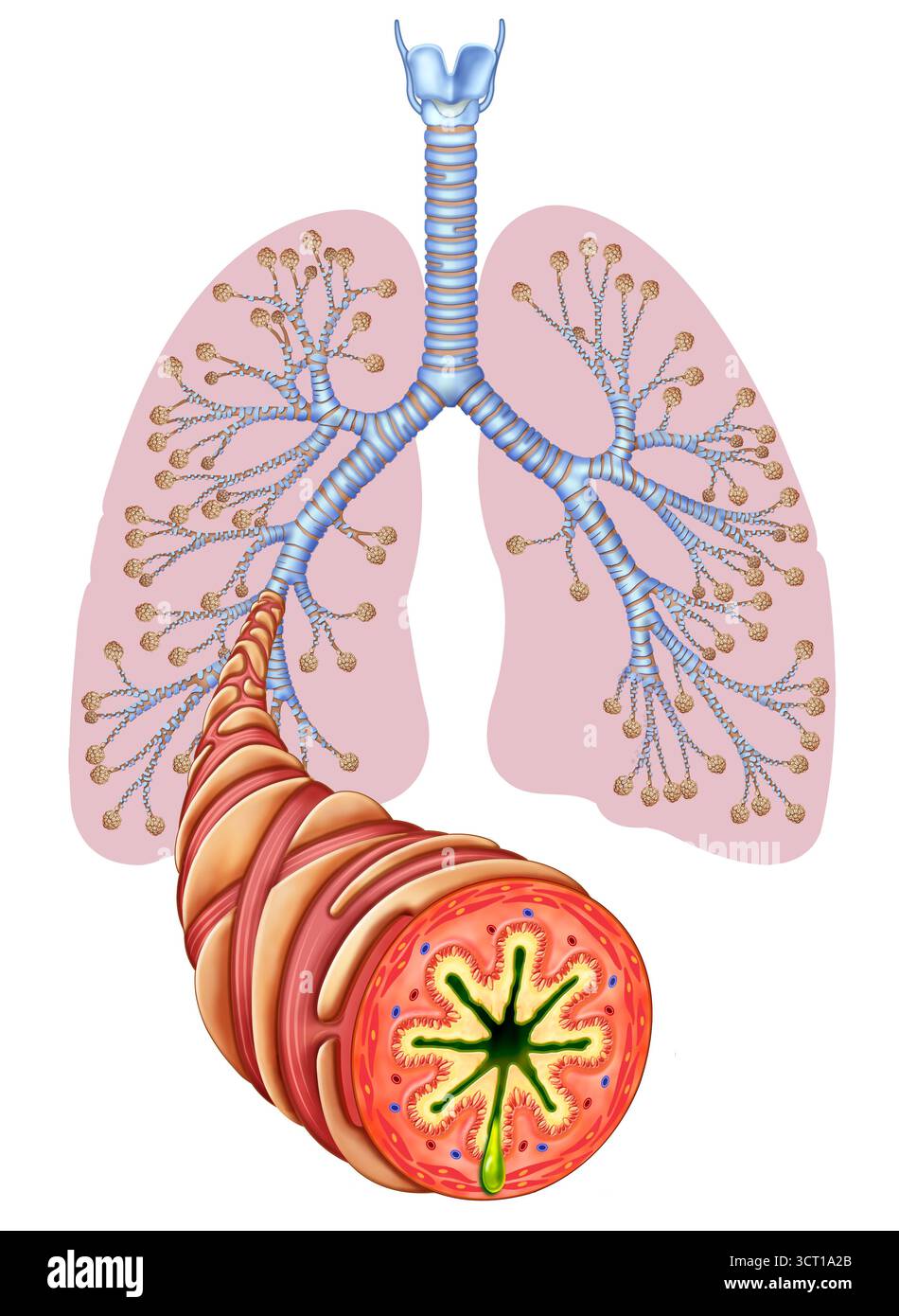 Illustration der Lunge und der asthmatischen Bronchialentzündung mit Hervorhebung eines Bronchus im Vordergrund. Asthma ist eine chronische Atemwegserkrankung, die durch Entzündungen und Verengung der Bronchien gekennzeichnet ist, die Atembeschwerden, Keuchen und Husten verursachen. Stockfoto