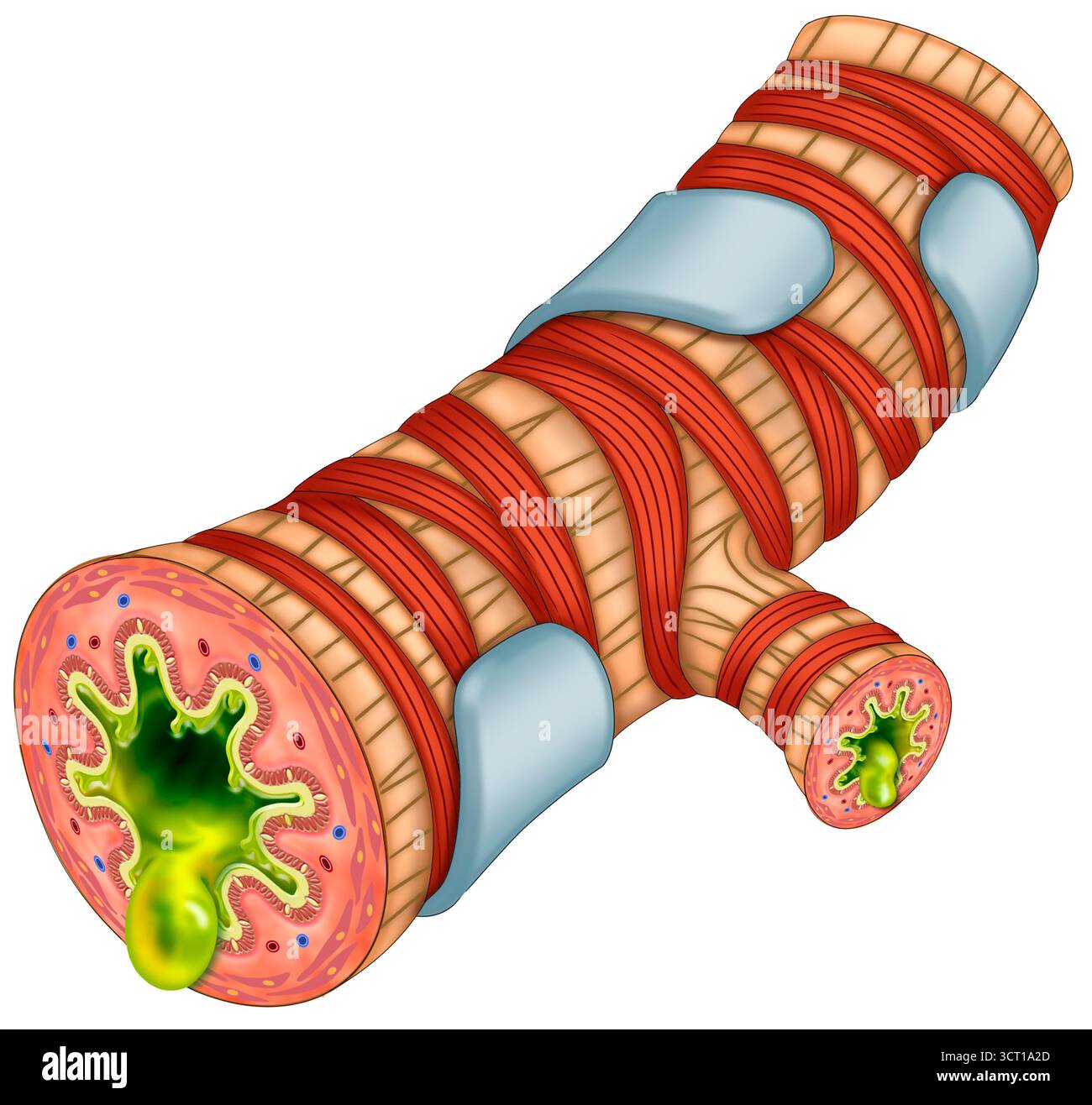 Darstellung eines Bronchitis-befallenen Bronchusabschnitts. Es zeigt Entzündungen, überschüssigen Schleim und Kontraktionen der glatten Muskulatur. Dies führt zu einer deutlichen Verengung dieser Atemwege. Stockfoto
