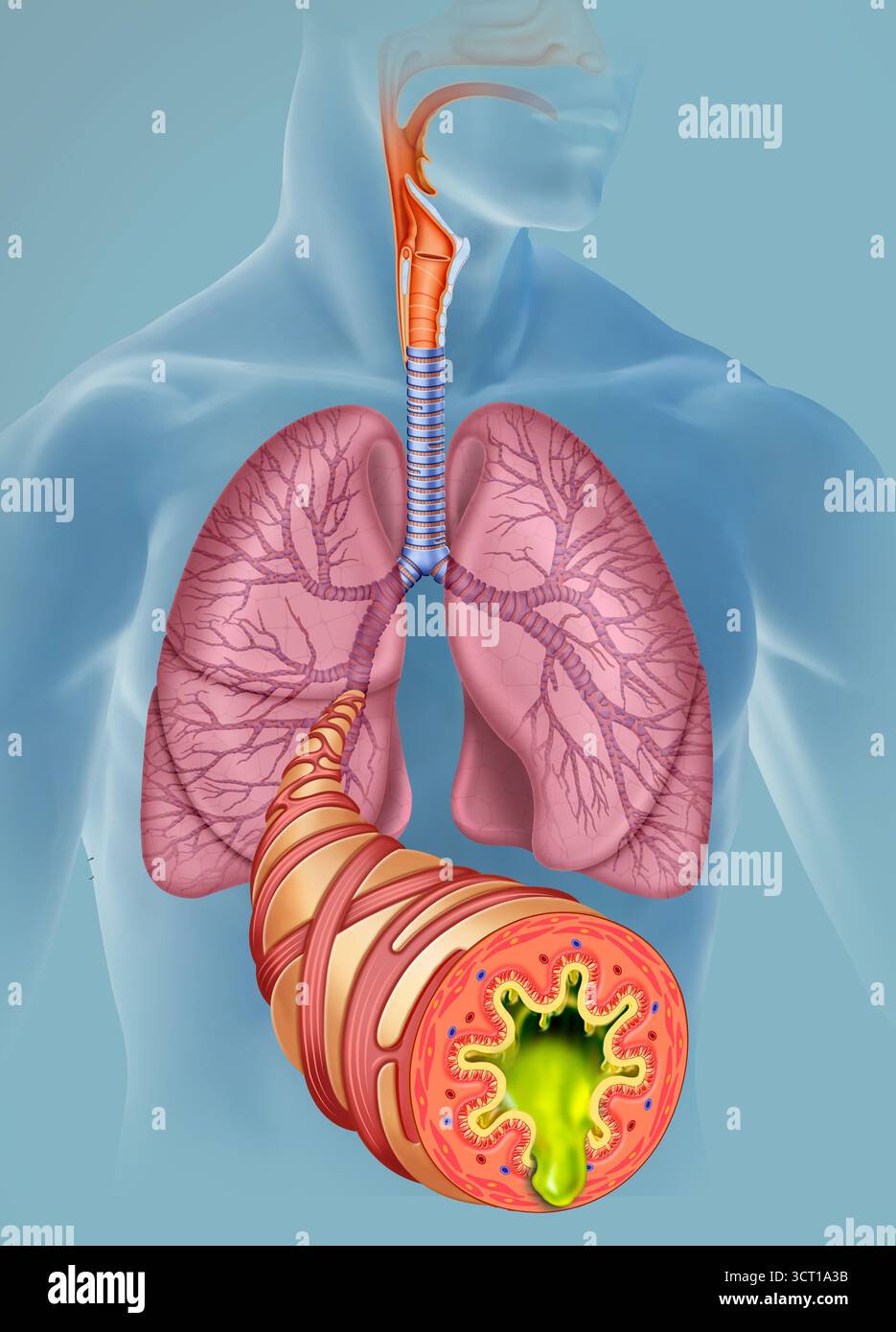 Abbildung einer menschlichen Figur, die das Atmungssystem zeigt, wobei die entzündeten Atemwege im Vordergrund hervorgehoben sind. Die akute Bronchitis ist eine Entzündung der Bronchien, die häufig durch Virusinfektionen verursacht wird. Seine Symptome umfassen anhaltenden Husten, Sputumproduktion und Atembeschwerden. Stockfoto