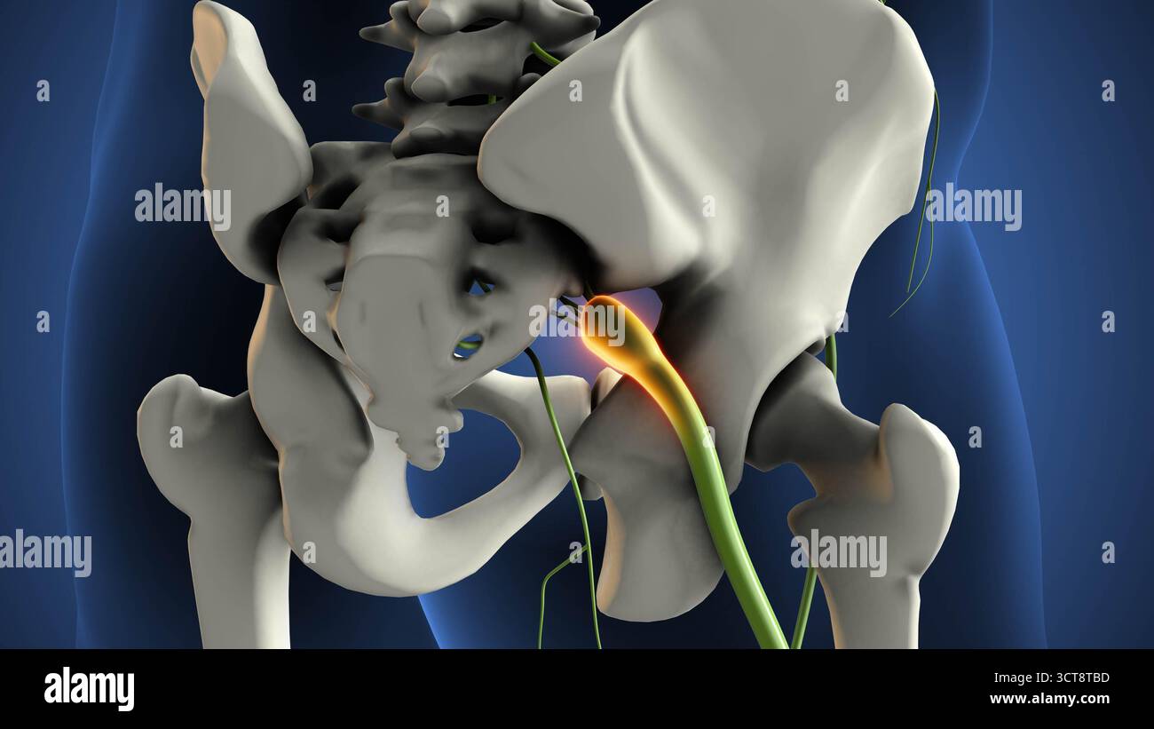 Rechtsseitiges Schwannom des Nervus Ischias Stockfoto