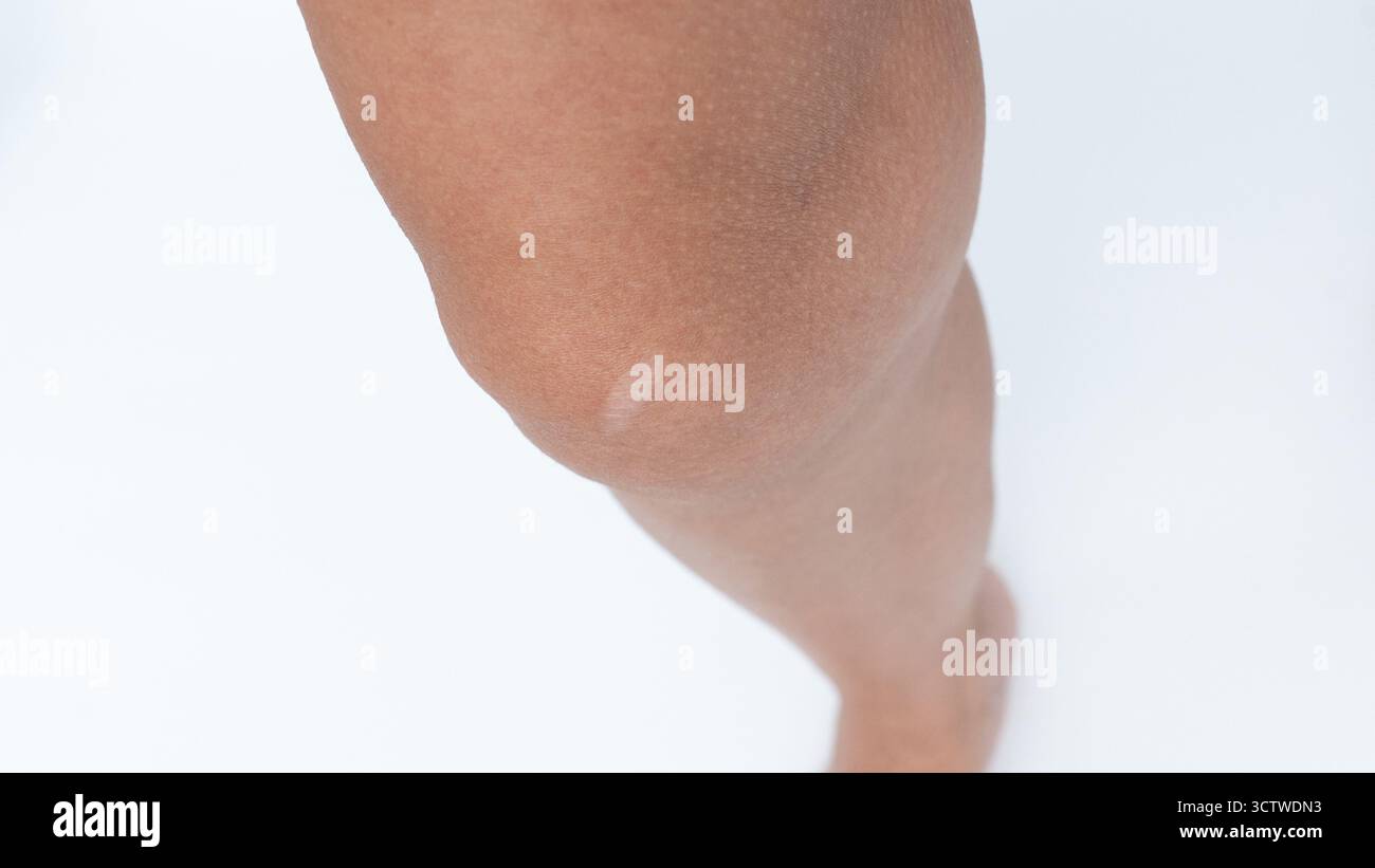 Nahaufnahme eines Kniegelenkes mit auffälliger Narbe, betont Hautstruktur und natürliche Schönheit vor einem weichen, minimalistischen Hintergrund mit Kopierraum Stockfoto