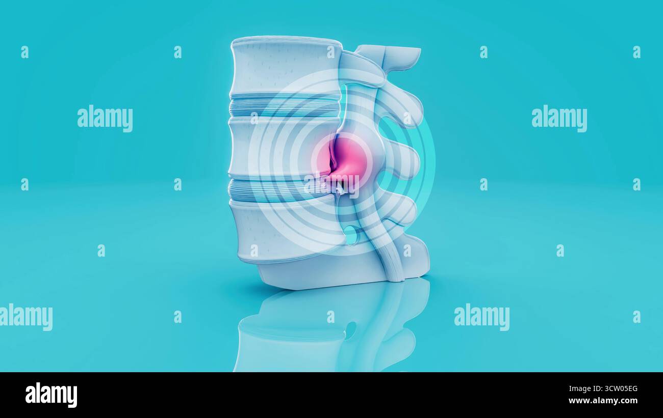 Konzeptionelle 3D-Darstellung eines Bandscheibenvorfalls in der Lendenwirbelsäule Stockfoto