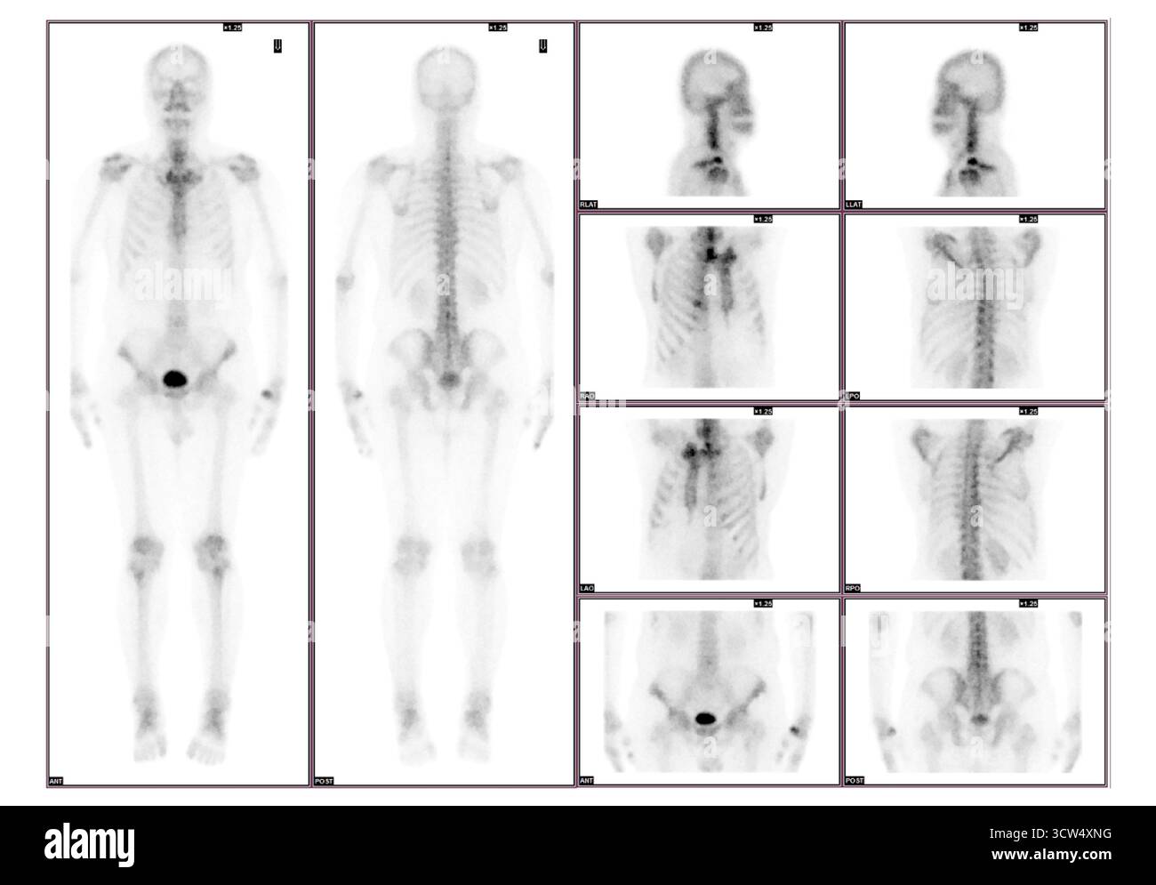 Eine Ganzkörper-Knochenuntersuchung wurde nach intravenöser Injektion von TC-99m MDP durchgeführt. Stockfoto