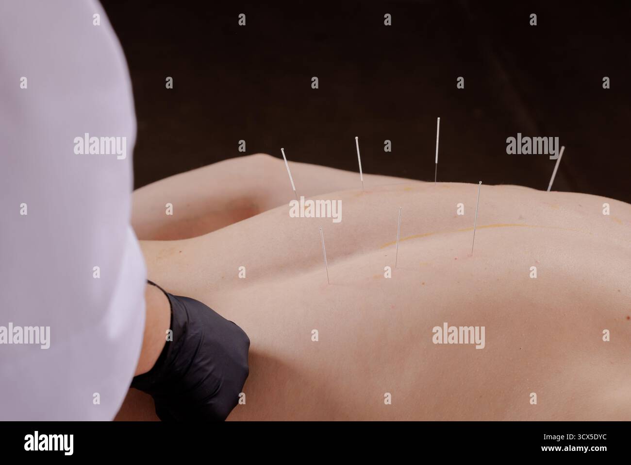 Nahaufnahme eines Therapeuten, der mit mehreren Nadeln Akupunktur auf dem Brustrücken durchführt, um Triggerpunkte zu behandeln und chronische Schmerzen in einer Klinik zu lindern Stockfoto