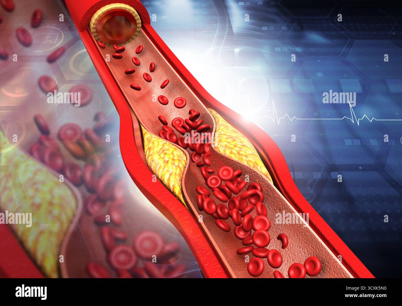 Verstopfte Arterien, Cholesterinplaque in der Arterie. 3D-Abbildung Stockfoto