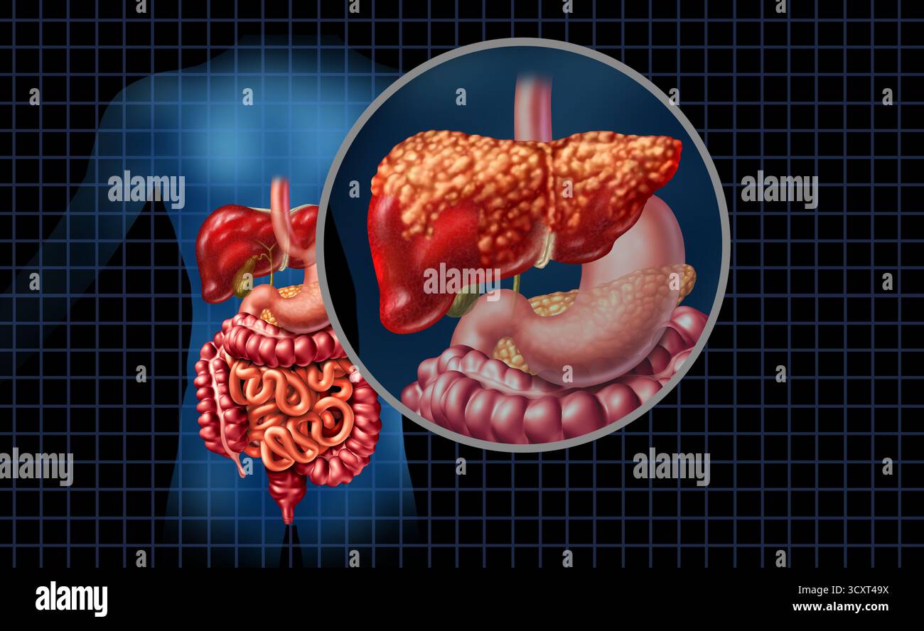 Fettleberkrankheit und Lebersteatose Körperteil als medizinisches Versorgungskonzept der Verdauungsanatomie und des lebenswichtigen Organs für Verdauungsspaß Stockfoto