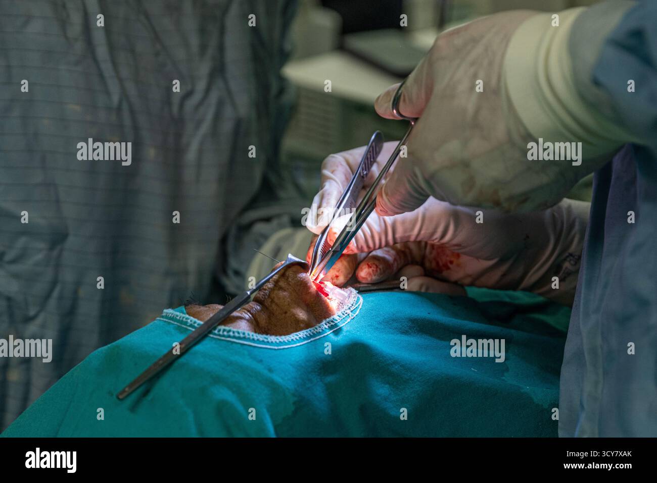 Ein kosmetischer Chirurg verwendet einen Nasenretraktor, um einen Hautgeweblappen zurückzuhalten, während er mit einer Rückenschere schneidet. Offene Rhinoplastik und Tip pl Stockfoto