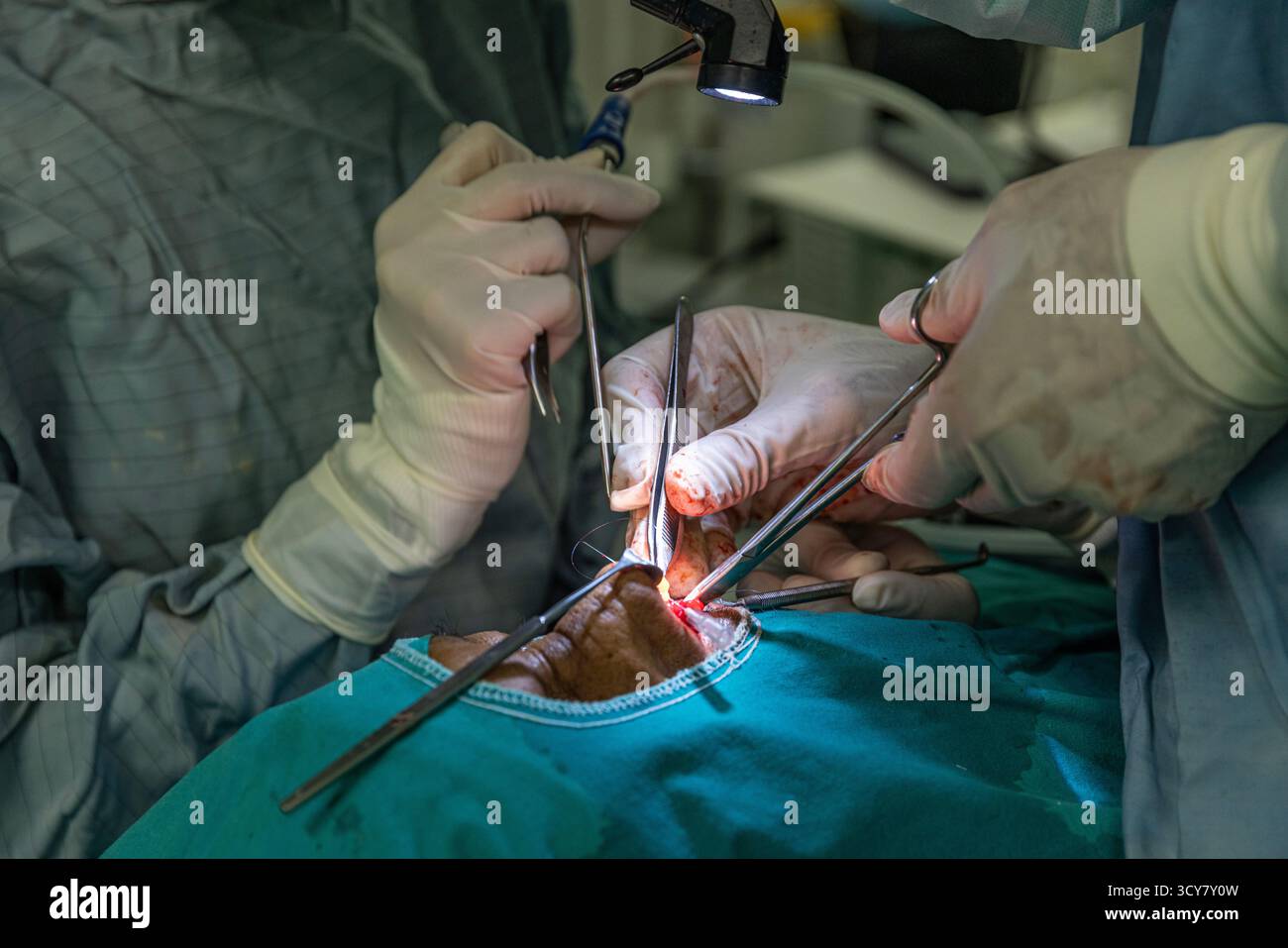 Ein kosmetischer Chirurg verwendet einen Nasenretraktor, um einen Hautgeweblappen zurückzuhalten, während er mit einer Rückenschere schneidet. Offene Rhinoplastik und Tip pl Stockfoto
