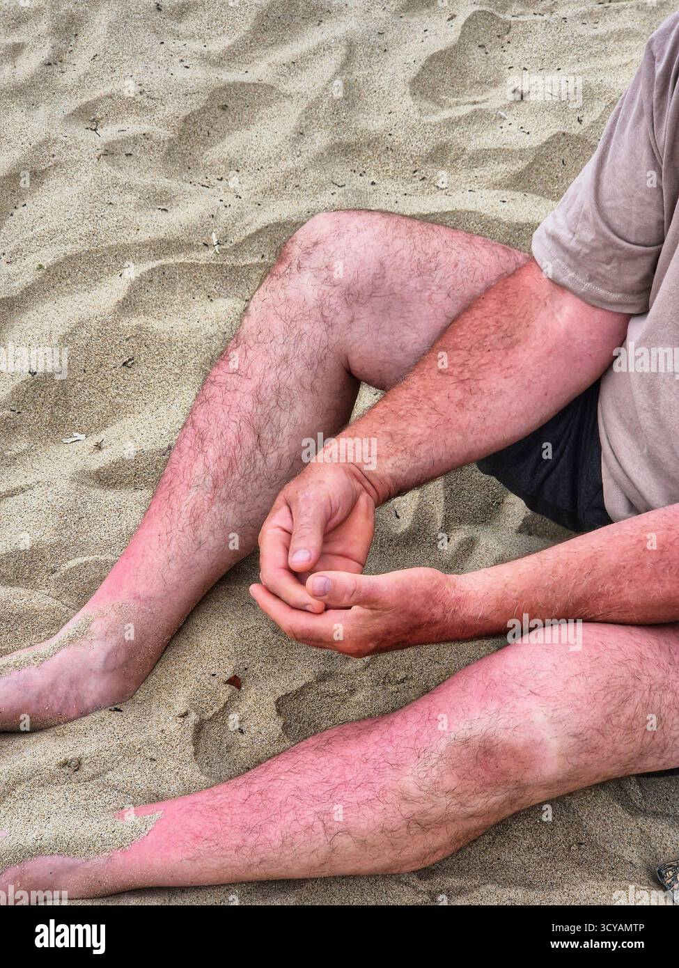 Beine eines Mannes mit rot gebräunter Haut. Mann auf Sand. Sonnenallergie. Empfindliche Haut. Seebraun Stockfoto