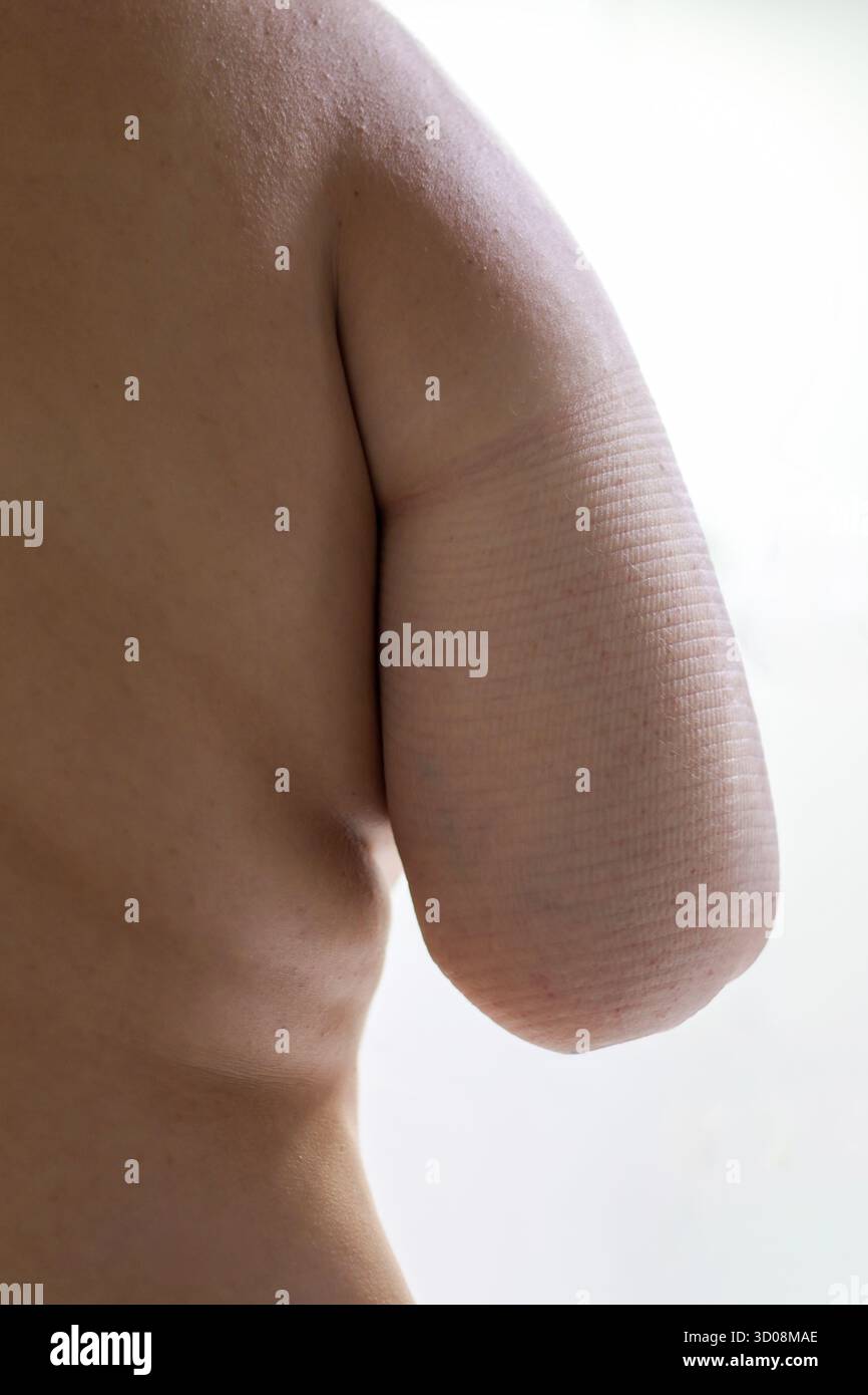 Der Oberkörper der Person zeigt einen amputierten Arm mit strukturierter Restgliedmasse, wobei Themen wie Behinderung, Gesundheit und Anpassung hervorgehoben werden Stockfoto