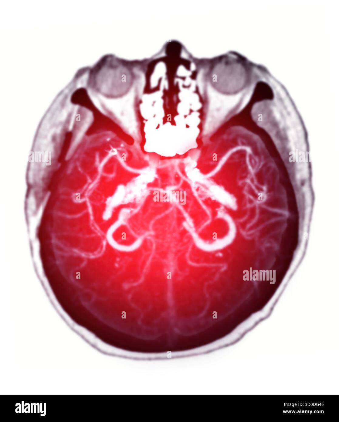 CTA Brain Vascular Imaging , Eine atemberaubende Darstellung des Gefäßsystems des Gehirns, rot beleuchtet, bietet einen Einblick in den Vitalkreislauf Stockfoto