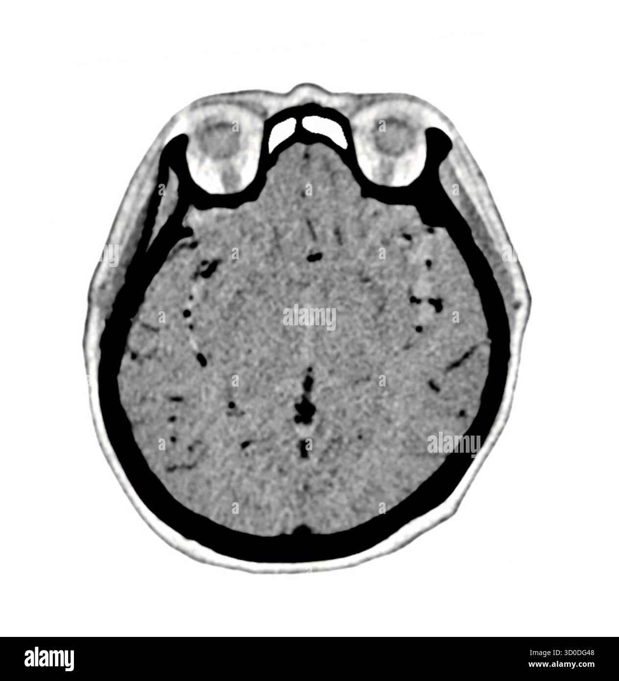 Ein klarer, schwarz-weiß-CT-Scan, der die normale Struktur des Gehirns zeigt und die unterschiedlichen Grenzen und das Fehlen von Anomalien hervorhebt. Stockfoto