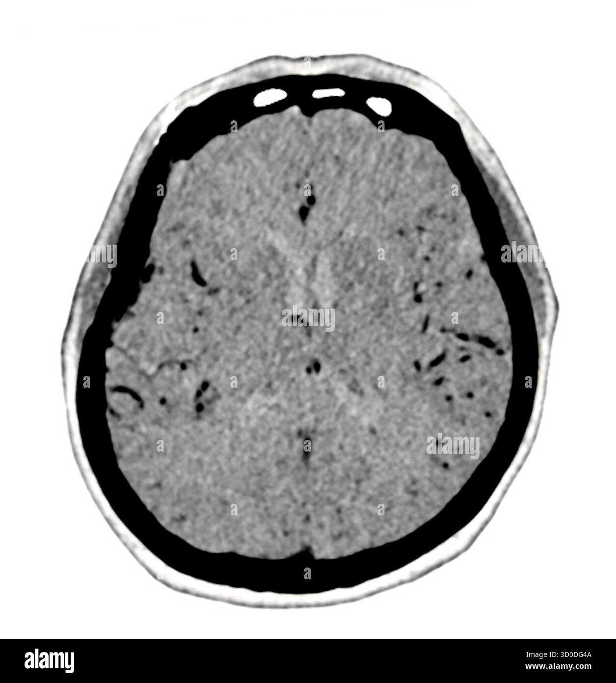 Ein klarer, schwarz-weiß-CT-Scan, der die normale Struktur des Gehirns zeigt und die unterschiedlichen Grenzen und das Fehlen von Anomalien hervorhebt. Stockfoto