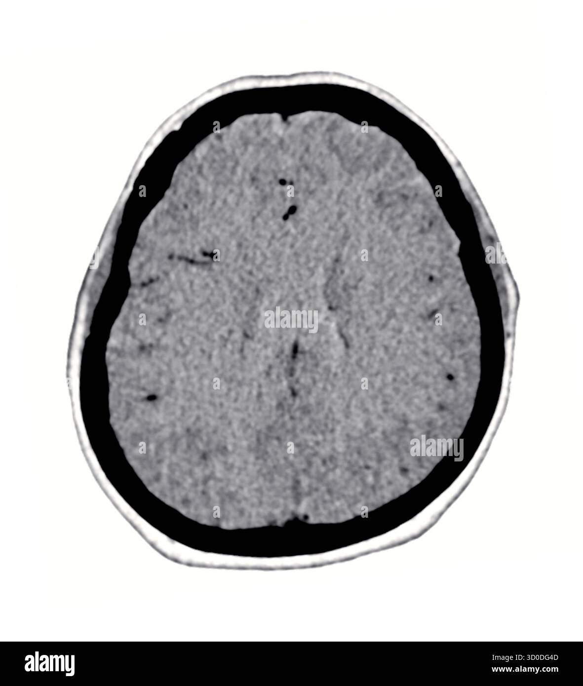 Ein klarer, schwarz-weiß-CT-Scan, der die normale Struktur des Gehirns zeigt und die unterschiedlichen Grenzen und das Fehlen von Anomalien hervorhebt. Stockfoto