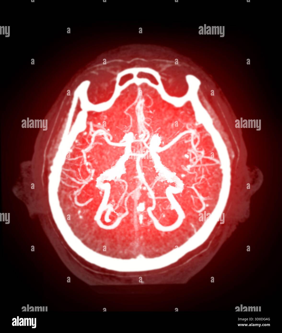 CTA Brain Vascular Imaging , Eine atemberaubende Darstellung des Gefäßsystems des Gehirns, rot beleuchtet, bietet einen Einblick in den Vitalkreislauf Stockfoto