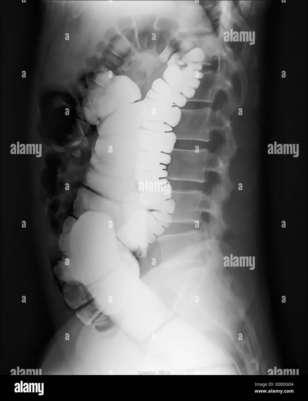 Ein diagnostisches Bariumeinlaufbild, das das Vorhandensein von Divertikulose im transversalen und ascendenden Kolon zeigt und das typische Divertikulär f demonstriert Stockfoto