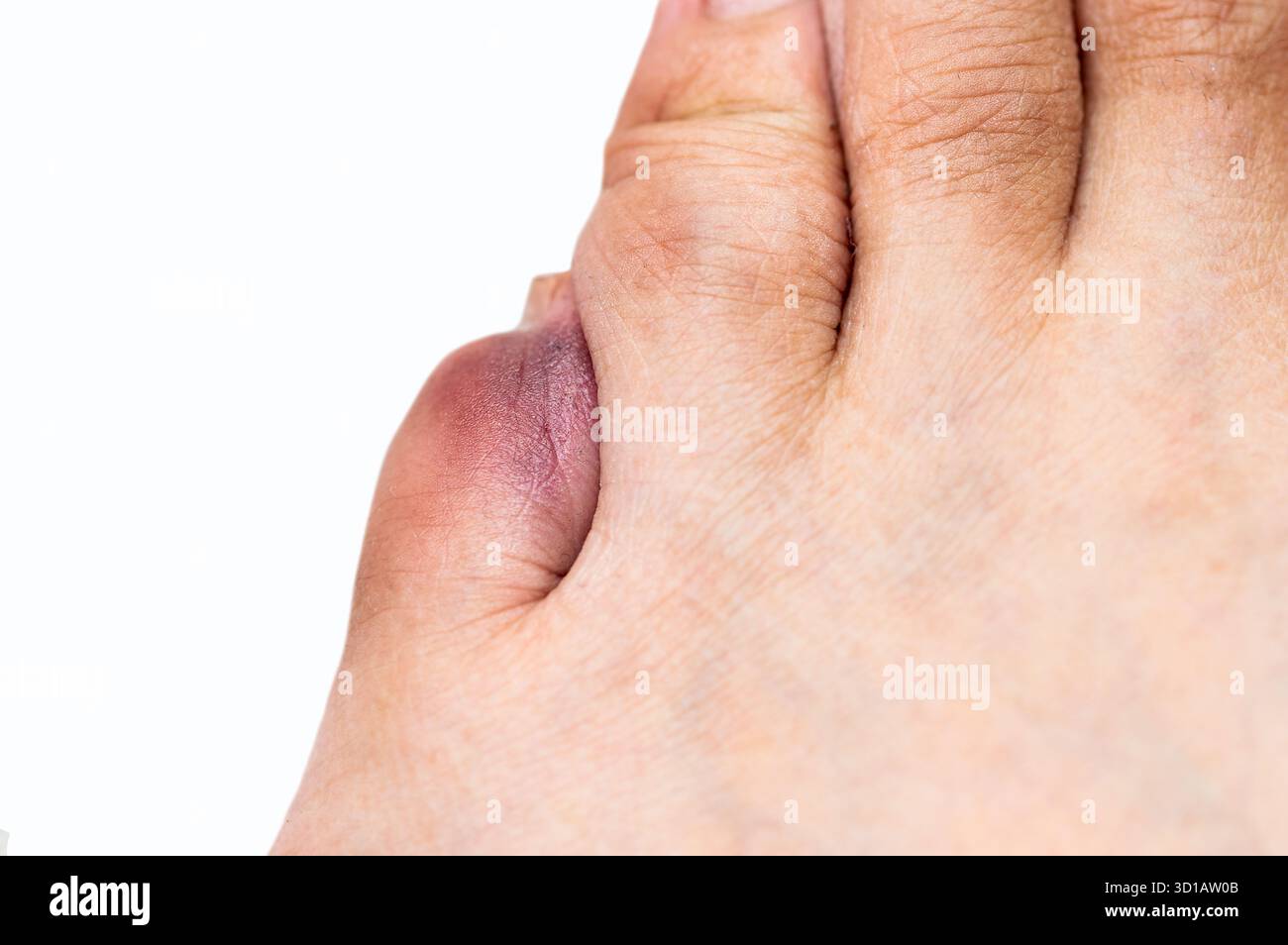 Mann kleiner Zeh mit violettem Bluterguss nach einem Hausunfall. Gebrochene Zehen- oder Phalanxfraktur mit weißem Hintergrund.Draufsicht. Stockfoto