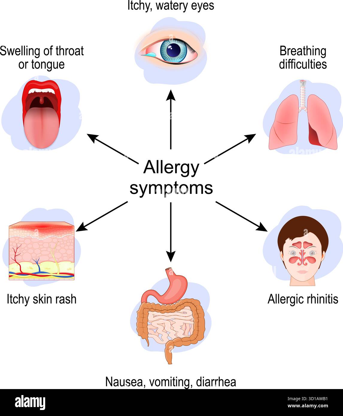 Allergiesymptome. Allergische Rhinitis, Atembeschwerden, Schwellung von Hals oder Zunge, Übelkeit, Juckreiz und Hautausschlag. Vektorabbildung Stock Vektor