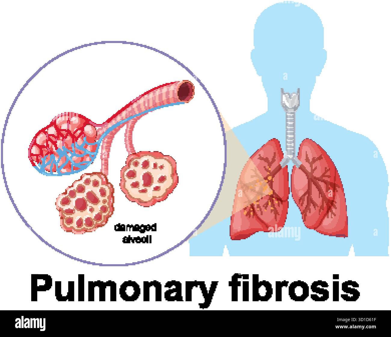 Vektordiagramm, das beschädigte Alveolen in der Lunge zeigt und die Lungenfibrose mit markierter Anatomie hervorhebt Stock Vektor